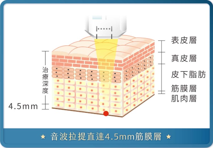 音波拉提-精準打擊面部鬆弛，刺激膠原蛋白增生-首爾醫美