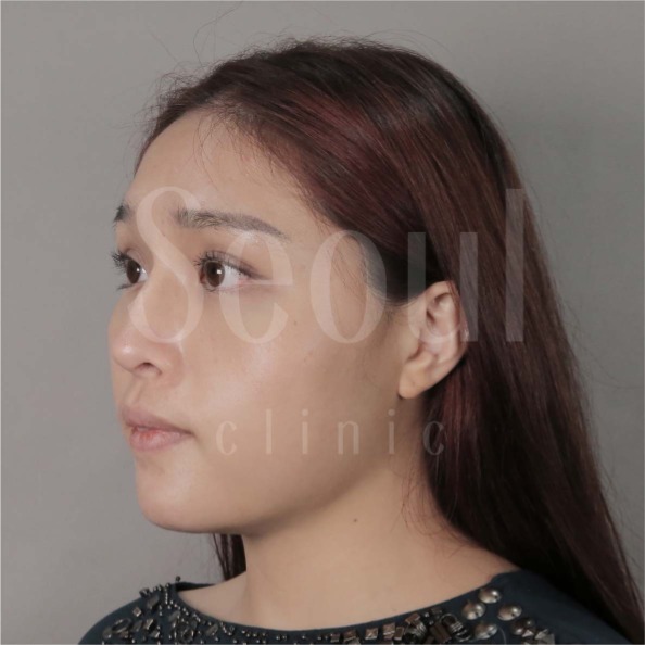 音波拉提-術前分享照-首爾醫美