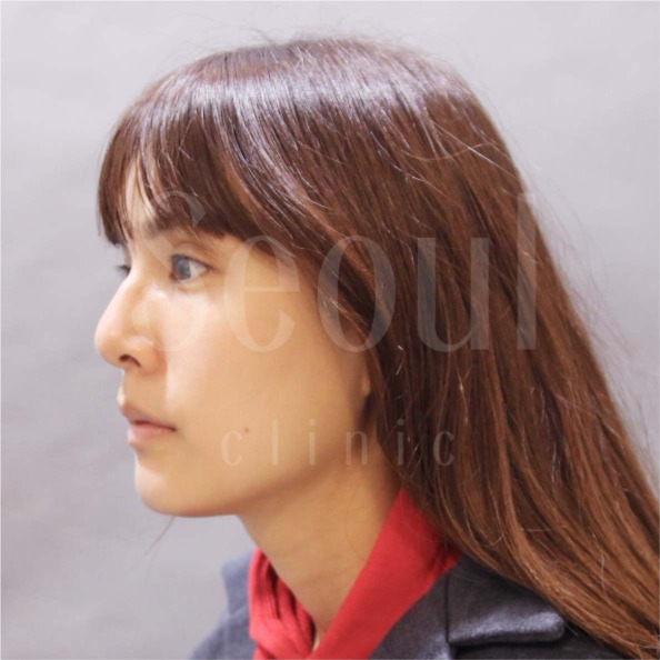 音波拉提-術前分享照-首爾醫美