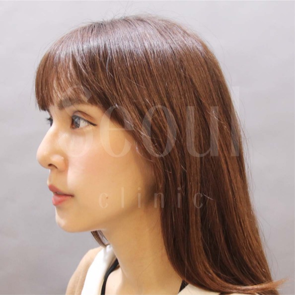 音波拉提-術後分享照-首爾醫美