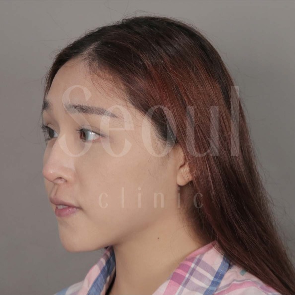 音波拉提-術後分享照-首爾醫美