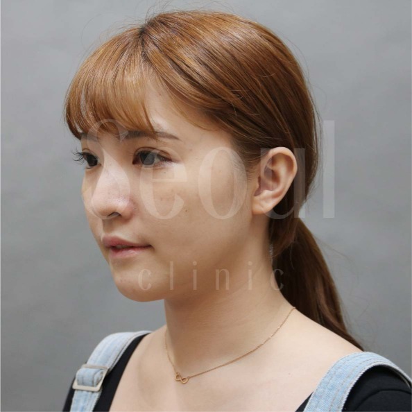 音波拉提-術前分享照-首爾醫美