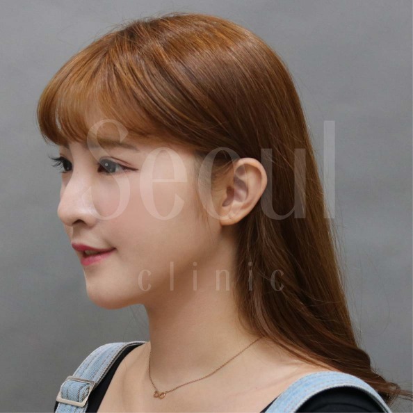 音波拉提-術後分享照-首爾醫美