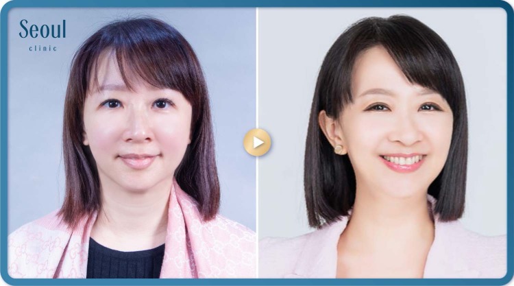 音波拉提-音波拉提術後分享-首爾醫美