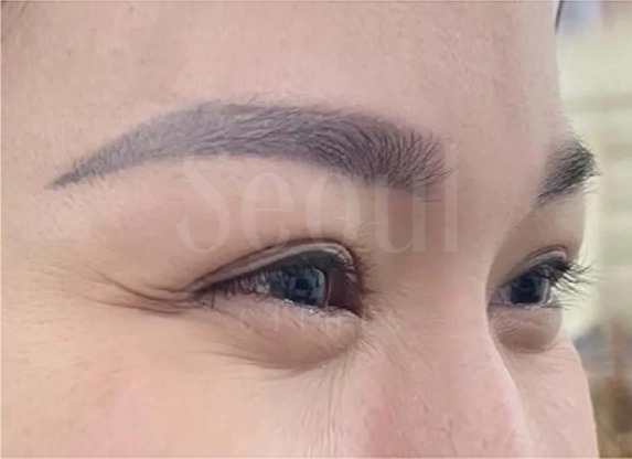 肉毒_肉毒魚尾紋前_首爾醫美