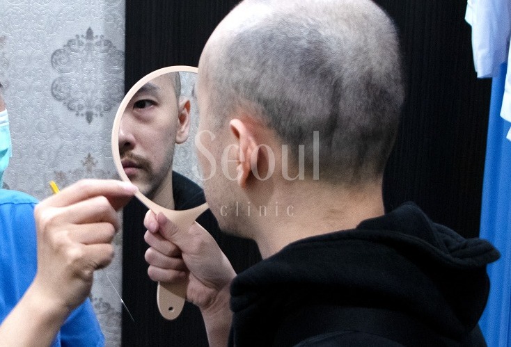 五合一眼袋手術-術前諮詢-首爾醫美診所