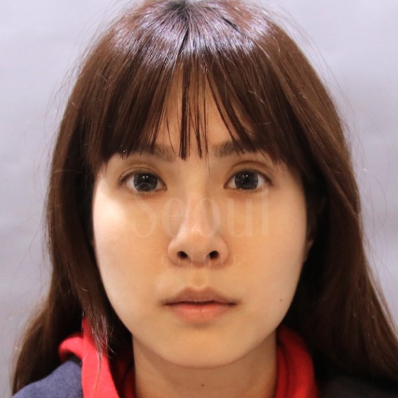 音波拉提_素人術前分享_首爾醫美