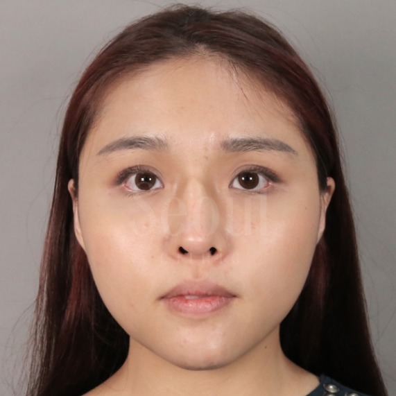 音波拉提_素人術前分享_首爾醫美