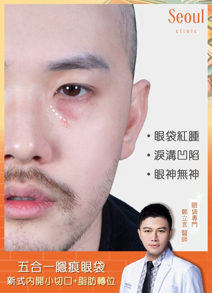 五合一眼袋手術-眼袋紅腫加上淚溝，視覺上精神不佳-首爾醫美診所