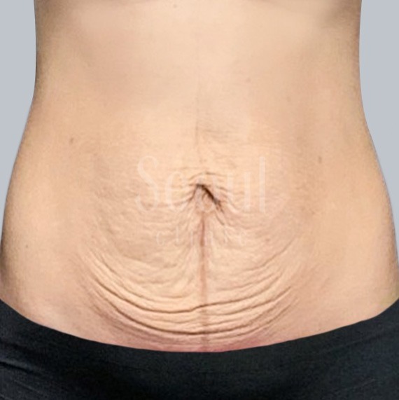 拉皮_術前案例_首爾醫美