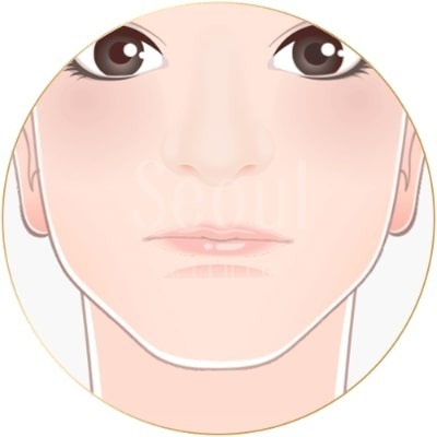 墊下巴_形狀調整_首爾醫美