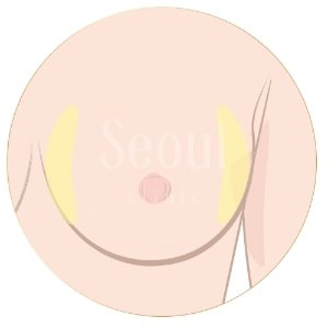 自體脂肪隆乳_內外側修型_首爾醫美