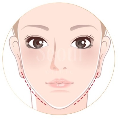 洢蓮絲_全臉緊緻_首爾醫美