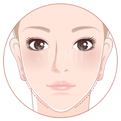 洢蓮絲_紋路撫平_首爾醫美