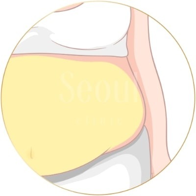抽脂手術_大範圍_首爾醫美
