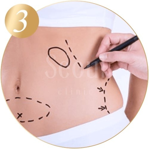 抽脂手術_部位標示_首爾醫美