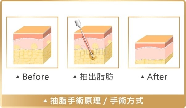 抽脂手術_手術原理_首爾醫美