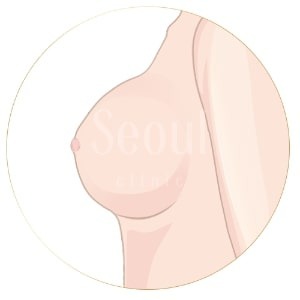 果凍矽膠隆乳_未達理想_首爾醫美