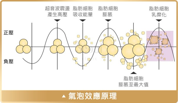 抽脂手術_氣泡效應原理_首爾醫美