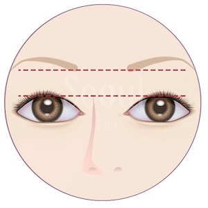提眼肌手術_眉眼間距寬_首爾醫美