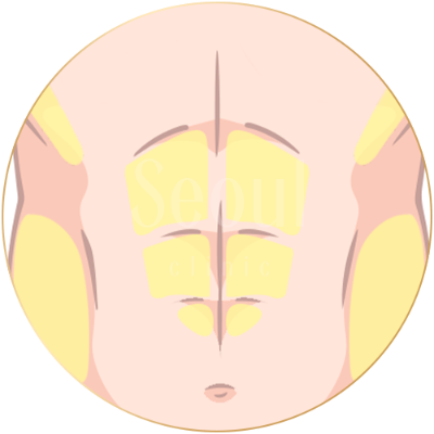 抽脂手術_細節精雕_首爾醫美