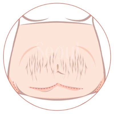 拉皮_頸部拉提_首爾醫美