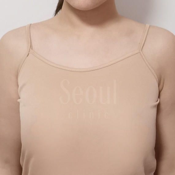 自體脂肪隆乳_術後護理衛教_首爾醫美