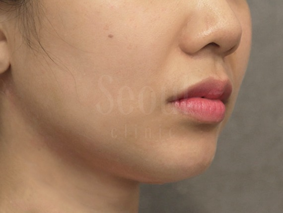 電波拉皮_術後案例_首爾醫美