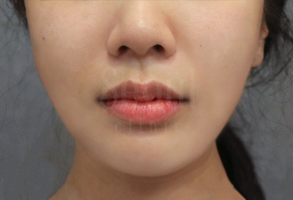 電波拉皮_術後案例_首爾醫美