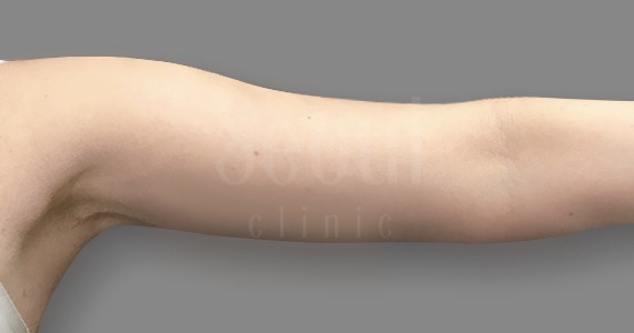 電波拉皮_術後案例_首爾醫美