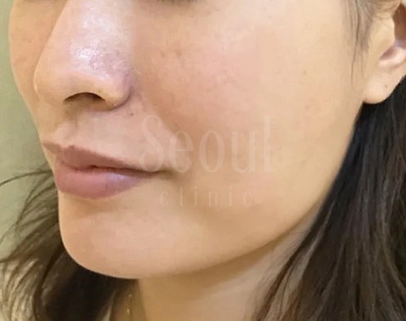 電波拉皮_術前案例_首爾醫美