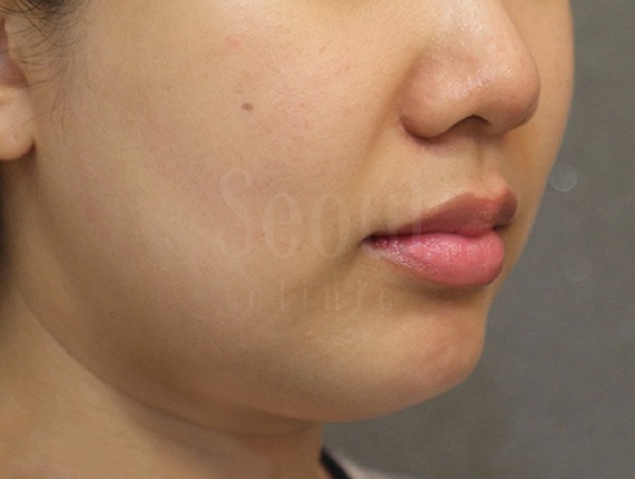 電波拉皮_術前案例_首爾醫美