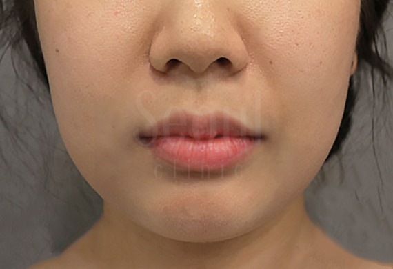 電波拉皮_術前案例_首爾醫美