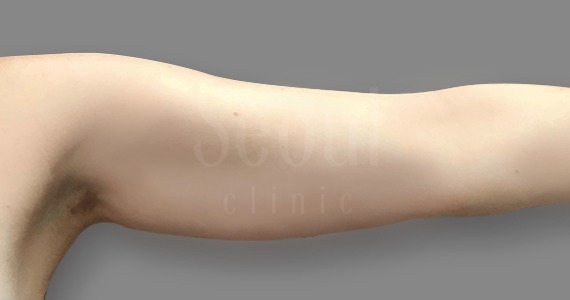 電波拉皮_術前案例_首爾醫美