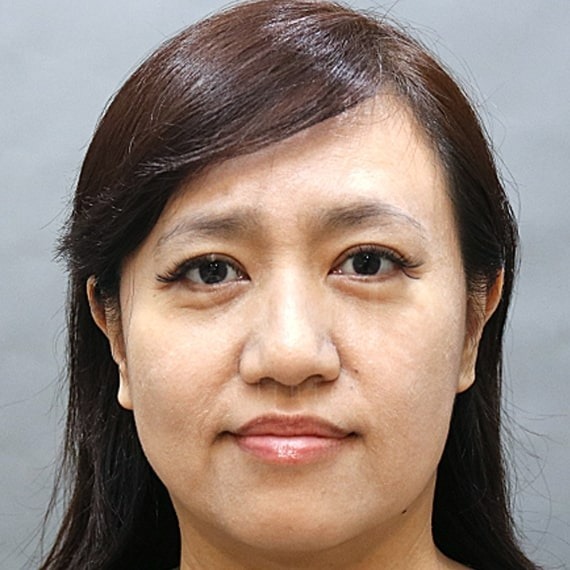 音波拉皮_術前案例_首爾醫美